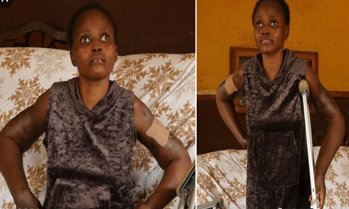 35 year-old Aderinsola Odebunmi is calling on well-meaning Nigerians to help in getting a sum of 5 Million  for hip replacement and plastic surgery from her buttocks down to her legs